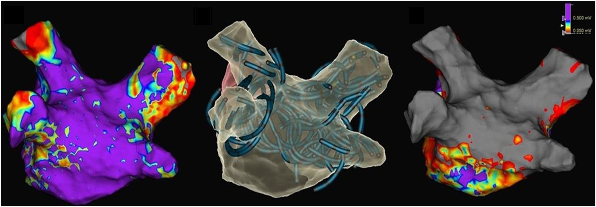 3D electro anatomical maps – pre ablation (left), post ablation (right), catheter placement shadows (middle) 